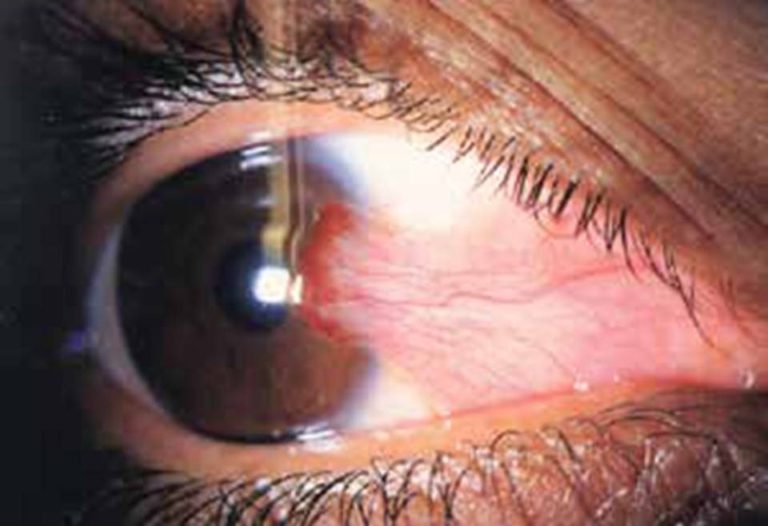 Pterygium Care Bundaberg Bundaberg Eye Clinic